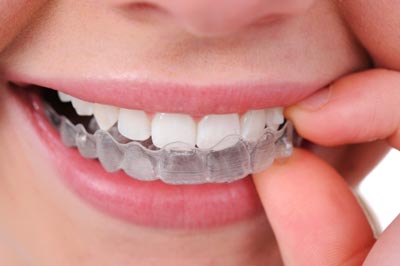 Aligner-Invisalign